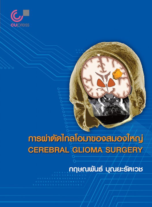 การผ่าตัดไกลโอมาของสมองใหญ่ (CEREBRAL GLIOMA SURGERY)