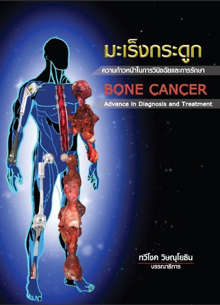 มะเร็งกระดูก :ความก้าวหน้าในการวินิจฉัยและการรักษา (Bone cancer: Advance in Diagnosis and Treatment)