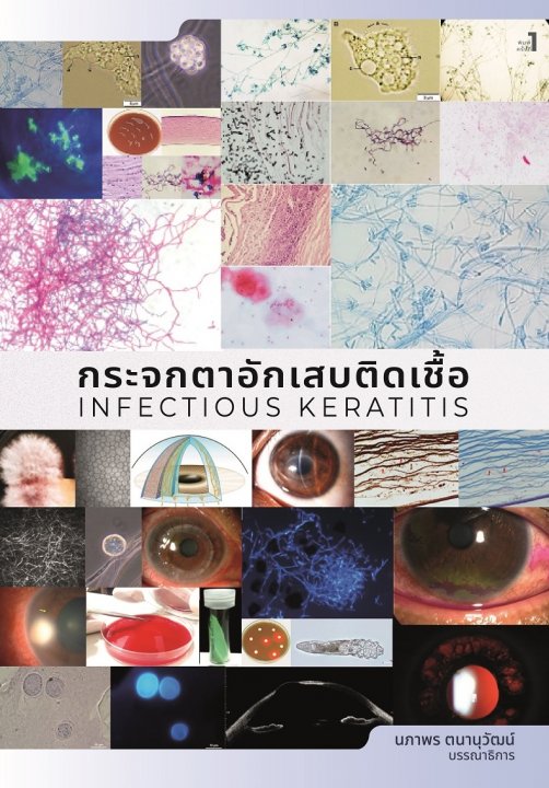 กระจกตาอักเสบติดเชื้อ (Infectious Keratitis)