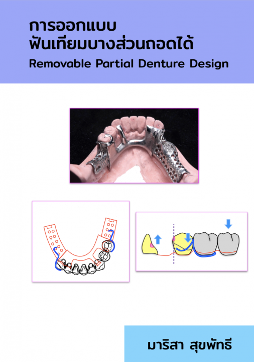 การออกแบบฟันเทียมบางส่วนถอดได้ (Removable Partial Denture Design)