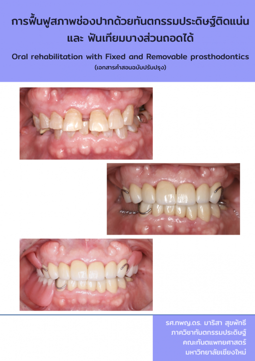 การฟื้นฟูสุขภาพช่องปากด้วยทันตกรรมประดิษฐ์ติดแน่น และ ฟันเทียมบางส่วนถอดได้