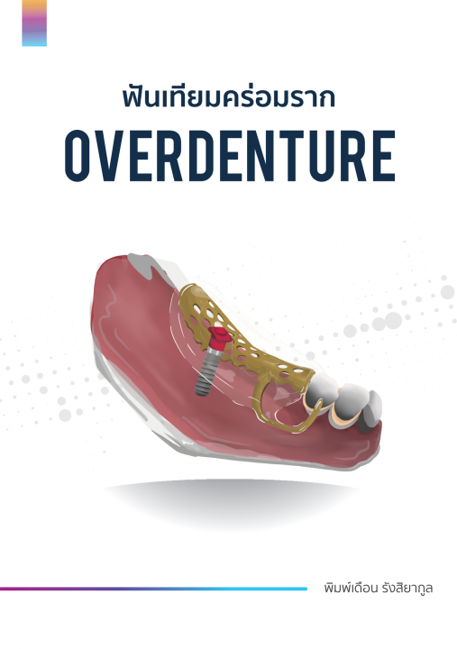 ฟันเทียมคร่อมราก (Overdenture)